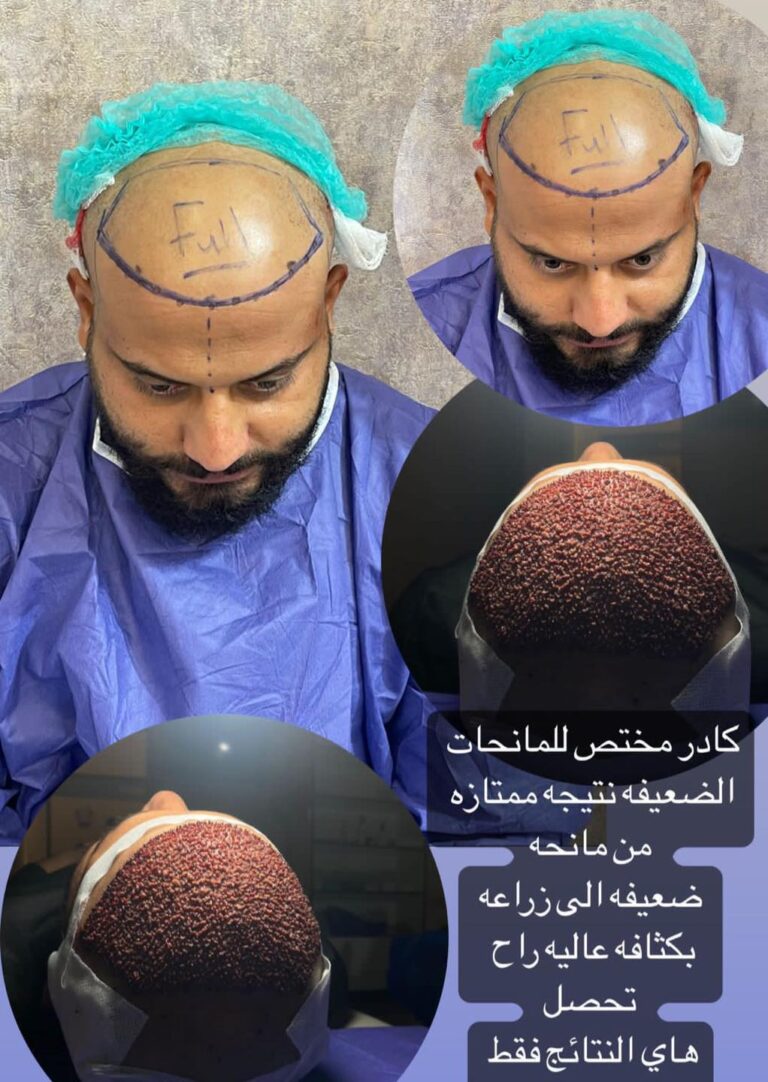 قبل وبعد زراعة 768x1082