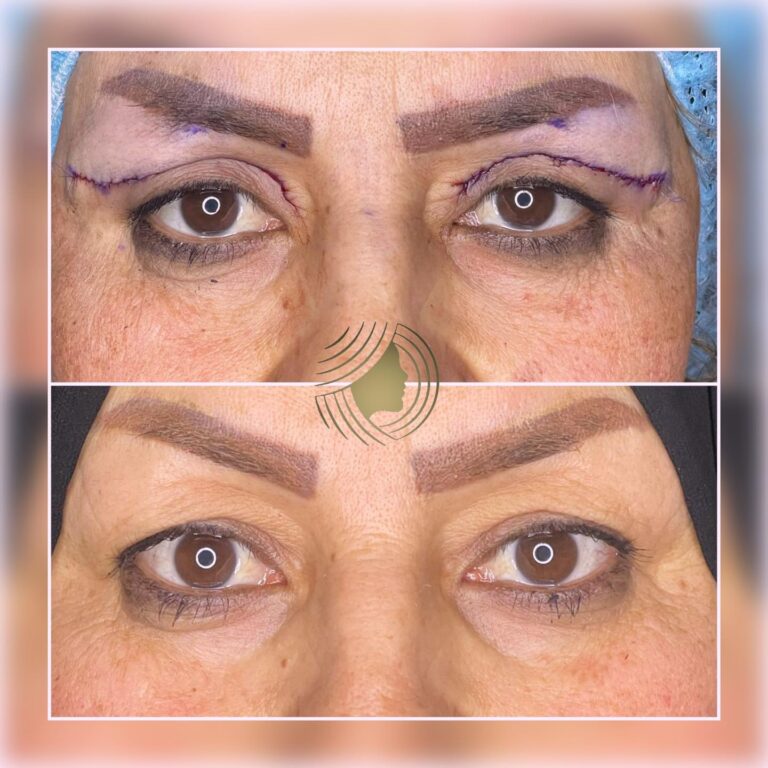 قص اجفان 1 768x768