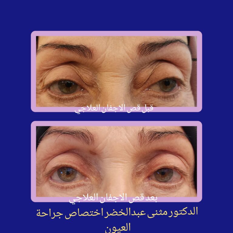 قص اجفان 2 768x768