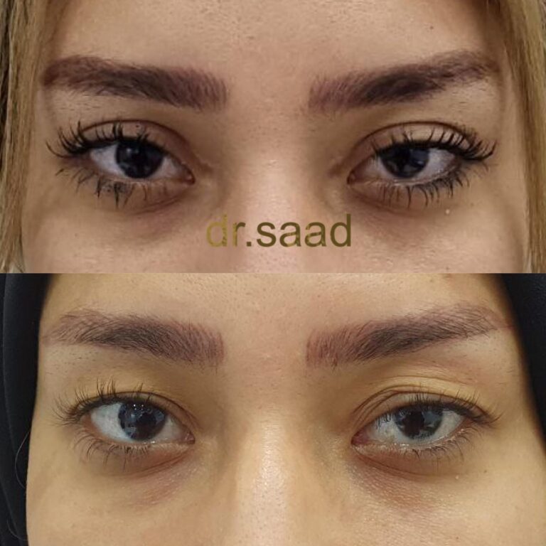 قص اجفان 3 768x768