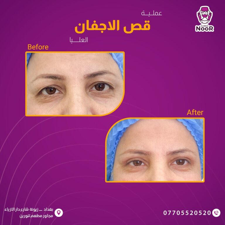 قص الاجفان 1 768x768