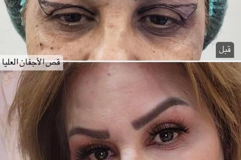 قص الاجفان 3 768x511