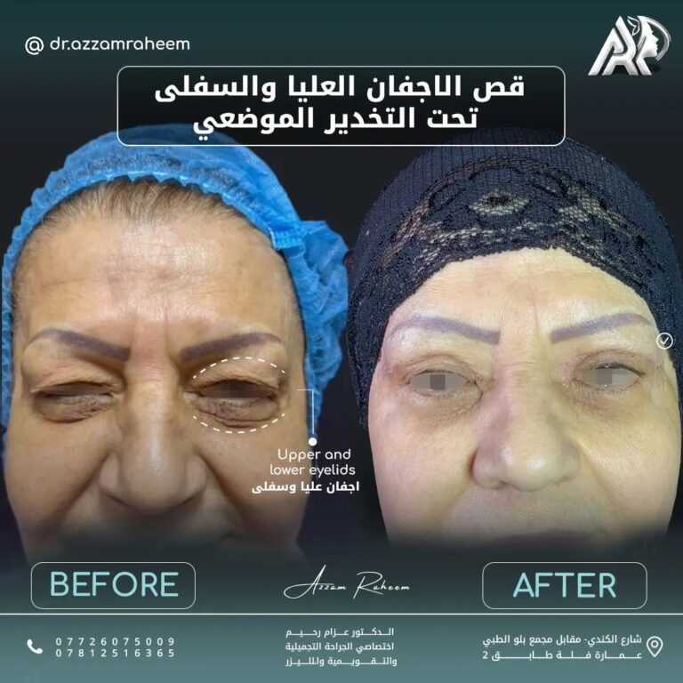 قص الاجفان 768x768