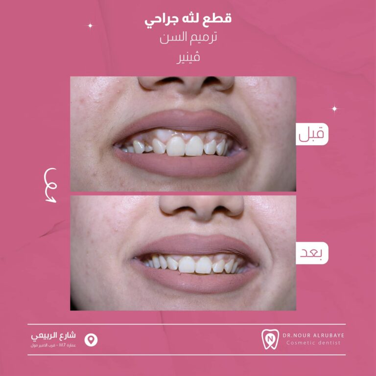 قطع لثه جراحيه 768x769