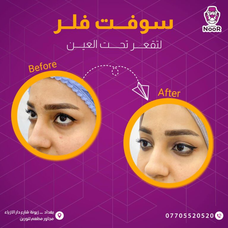 لتقعر تحت العين 768x768