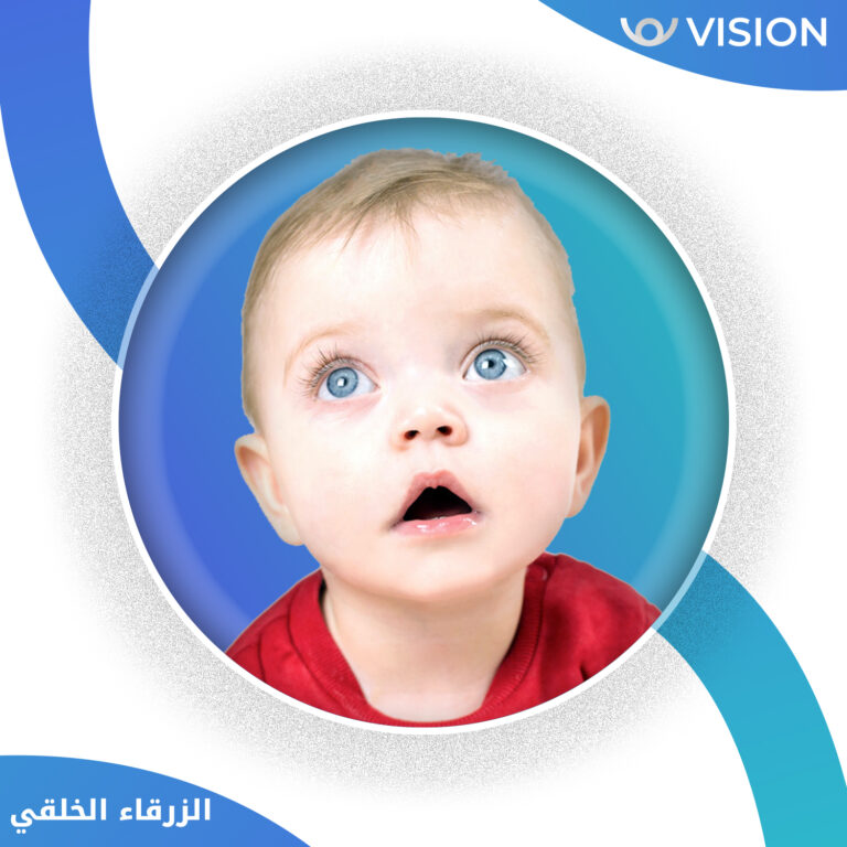 لزرقاء الجلوكوما الخلقية 768x768