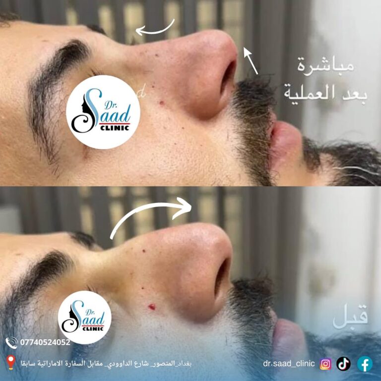 للرجال تجميل الانف 768x768