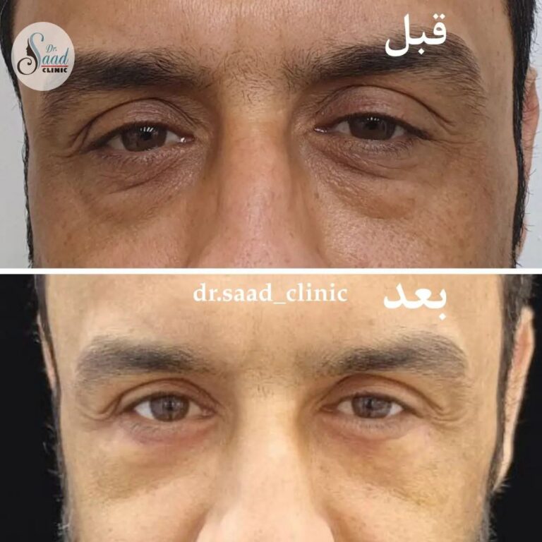 للرجال قص اجفان 768x768