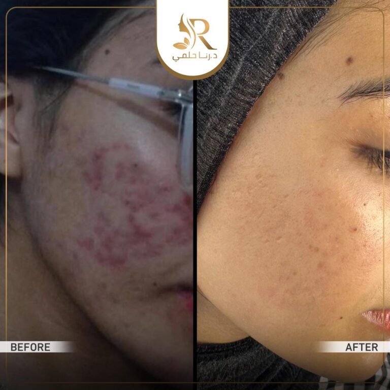 ليزر للاحمرار والاثر 768x768