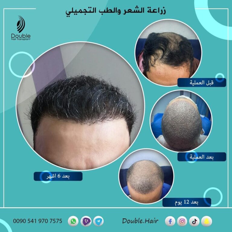 مراحل زراعة 768x768