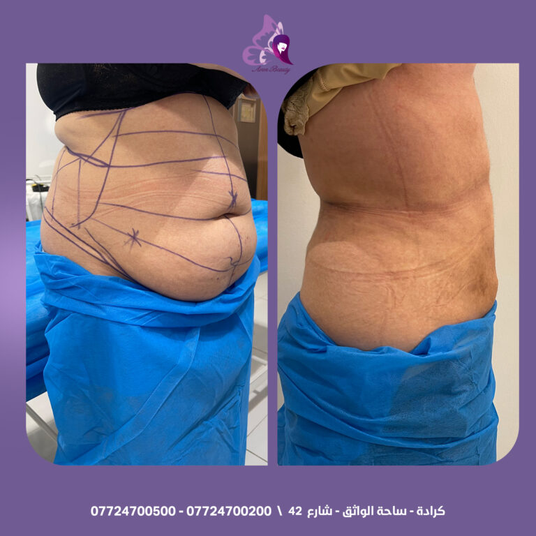 نحت البطن 1 768x768