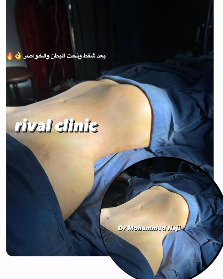 نحت البطن والخواصر 1 768x960