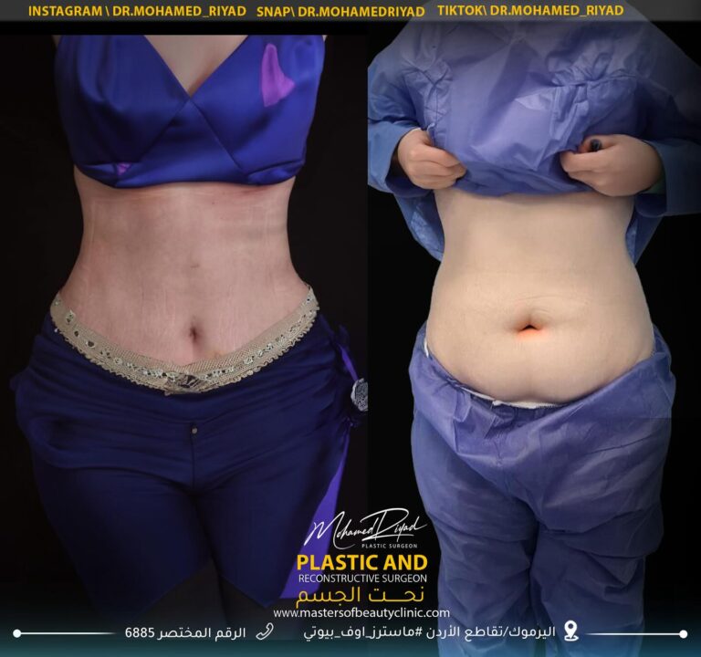 نحت الجسم 768x720