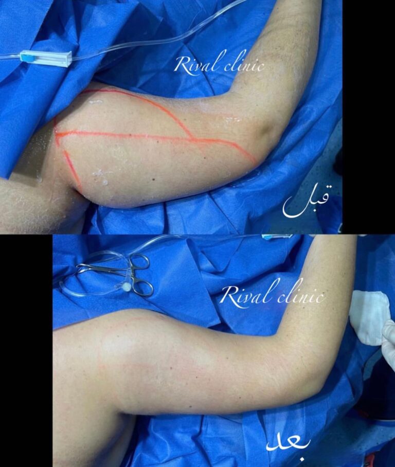 نحت الذراعين 768x908