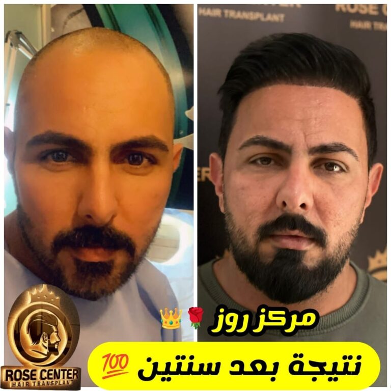 وداعا للصلع 768x768